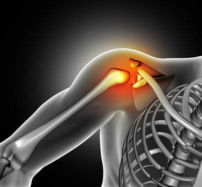 Shoulder Sprain, Strain Treatment in NYC | Shoulder Doctors Specialists