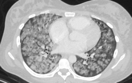 Diffuse alveolar haemorrhage | Radiology Case | Radiopaedia.org