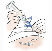 Gastrostomy Feeding Tube Care: Flushing | Saint Luke's Health System