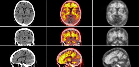 Amyloid-PET. A positive amyloid-PET scan in the three orthogonal planes ...