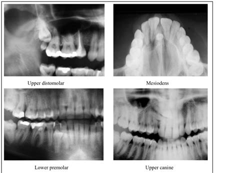 X-ray images showing different supernumerary teeth locations ...