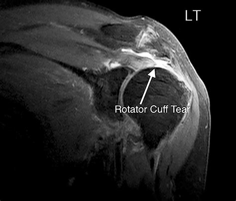 Should we repair rotator cuff tears – and if so, why, when and how ...