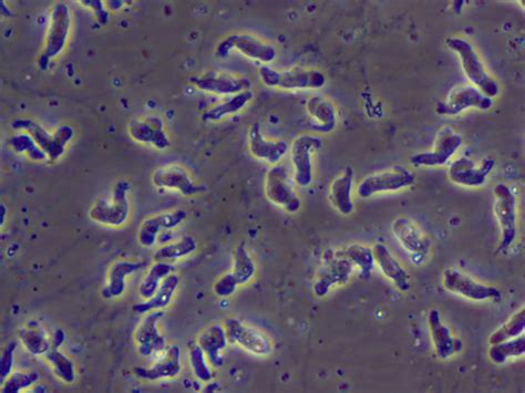 Naegleria fowleri amoeba or brain eating amoeba infection and treatment