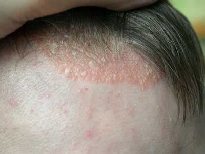 Shingles on scalp-Causes, 13 Symptoms, 12 Treatments