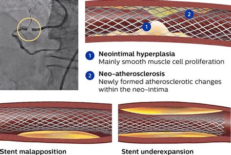 In-stent restenosis | Philips