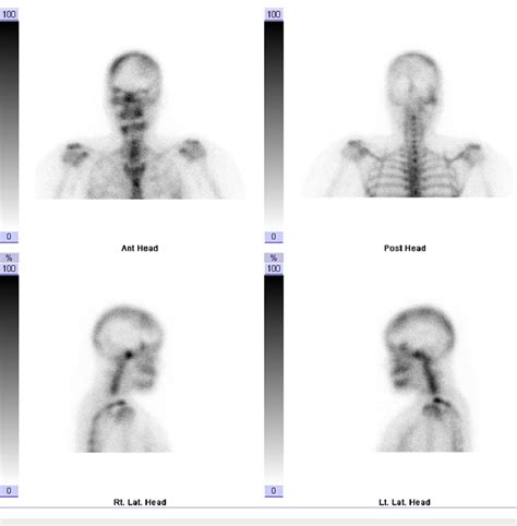 Three-phase bone scan. Three-hour delayed planar images demonstrating ...