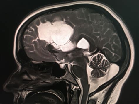 Epidermoid cyst | Radiology imaging, Epidermoid cyst, Mri