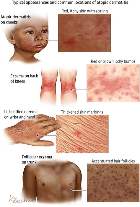 Atopic Dermatitis | Atopic dermatitis, Dermatology nurse, Medical knowledge