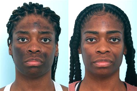 Chemical Peels Photos | Houston, Tx | Patient 10039