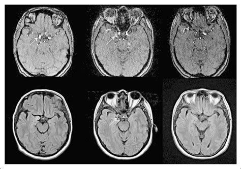 MRI imaging of changes in aneurysm size and flow over time in patient 9 ...