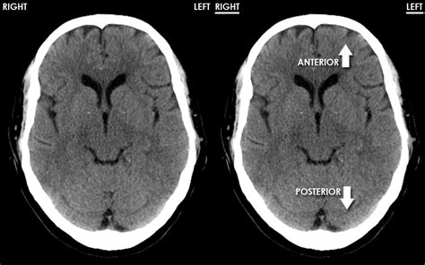 CT Brain Anatomy - Tutorial introduction