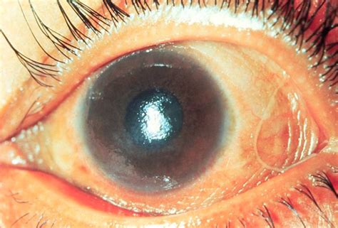 Corneal xerosis | Flickr - Photo Sharing!