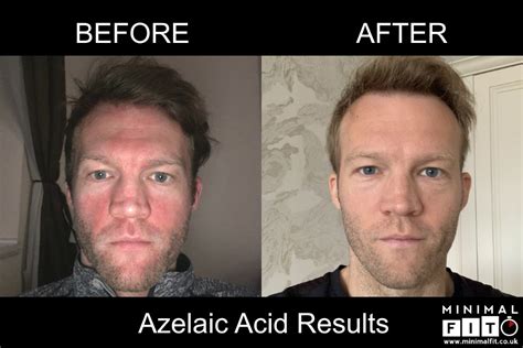 How I Cured Rosacea Using Azelaic Acid (Before & After Pics) | Minimal FIT