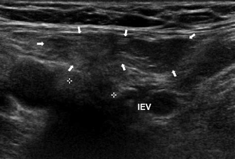 Direct Inguinal Hernia A Ultrasound Scan Uss Of The Inguinal | Images ...