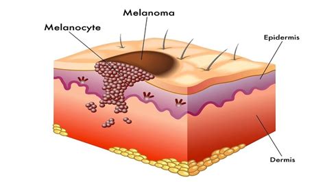 Understanding Melanoma - AIM at Melanoma Foundation