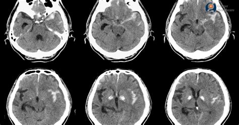 Subarachnoid Hemorrhage: Symptoms, Causes, Risk Factors , Diagnosis ...