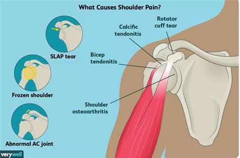 Causes of Shoulder Pain and Treatment Options - Sports Medicine Weekly ...