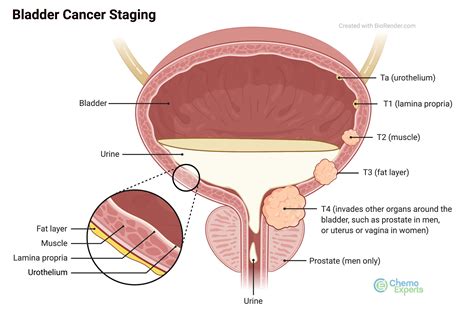 Bladder Cancer and Treatments | ChemoExperts