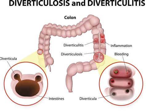 Diverticulitis: Causes, symptoms, and treatments