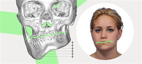 Asymmetrical Jaw Chin: Causes And How To Fix It Naturally, 46% OFF