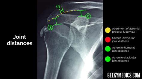 X Ray Normal Shoulder