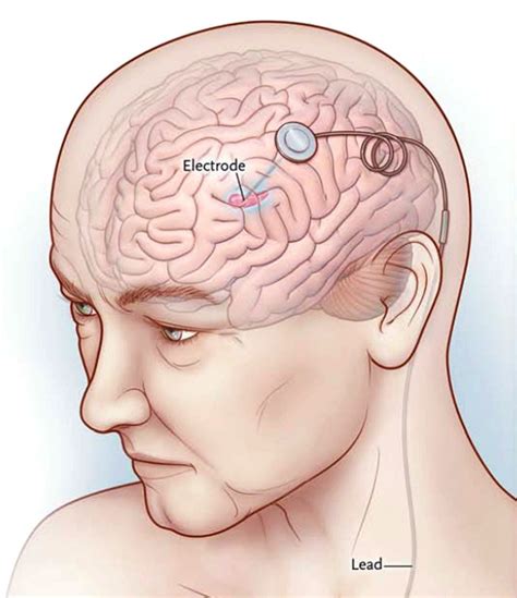 Pain Pacemakers for the Brain: Deep Brain Stimulation - Dr. Paul Christo MD