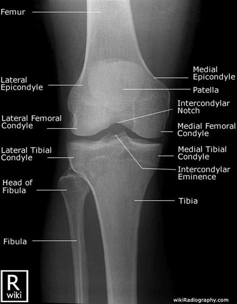 Normal Knee X Rays Bone And Spine | Images and Photos finder