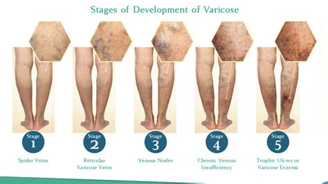 Venous Reflux Disease | Chronic Venous Insufficiency Stages | Venous ...