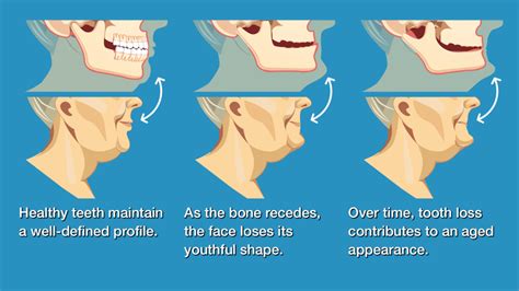 Wisdom Teeth Nerve Damage – Boston Dentist – Congress Dental Group 160 ...