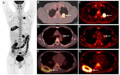 Diagnostics | Free Full-Text | Dynamic and Static 18F-FDG PET/CT ...