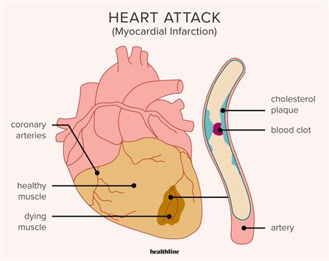 Heart attack symptoms causes diagnosis prevention more – Artofit