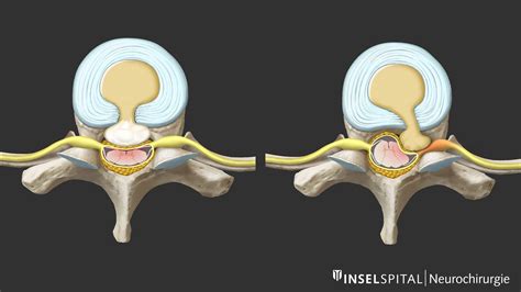 Herniated Disc Thoracic Mri