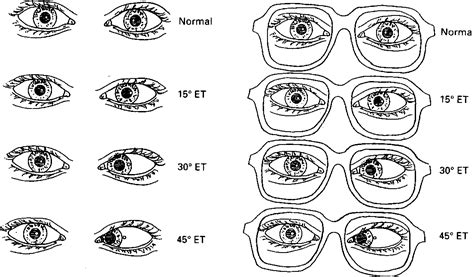 Figure 6 from corneal reflex test in spectacle wearers . Mathematical ...