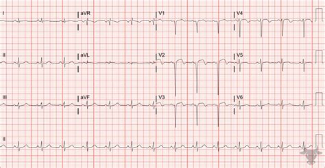 Left Ventricular Aneurysm | ECG Stampede