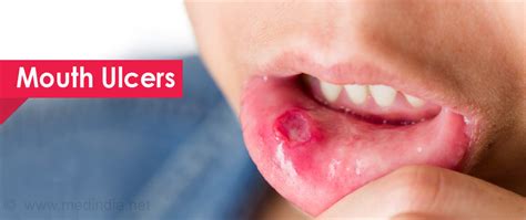 Mouth | Oral Ulcers - Causes, Symptoms, Diagnosis, Treatment and Prevention