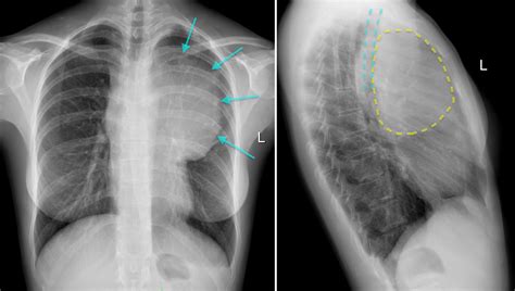 Anterior mediastinal mass - Radiology at St. Vincent's University Hospital