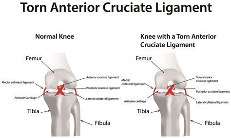 Knee ACL Surgery | EmergeOrtho—Triangle Region