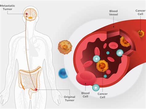 Metastatic Colorectal Cancer May Spread Early - NCI