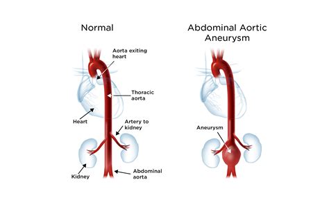 Abdominal Aortic Aneurysm Guide Causes Symptoms And Treatment Options ...