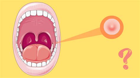 Why do I have a bump on my mouth inside the cheek (pictures)