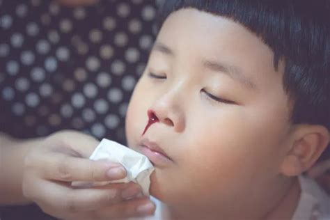 Nosebleeds in Children: Everything You Need to Know | Kids Clinic Singapore