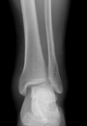 Distal tibia fibula fracture - kopolkiwi