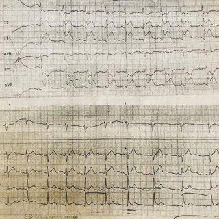 Posterior and right-sided ECG leads in the first electrocardiogram from ...