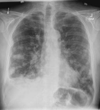 Pathology Outlines - Metastastic tumors to lung