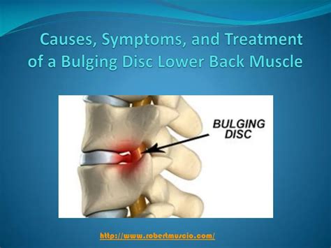 PPT - Causes, Symptoms, and Treatment of a Bulging Disc Lower Back ...