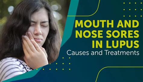 Mouth and Nose Sores in Lupus: Causes and Treatments | MyLupusTeam