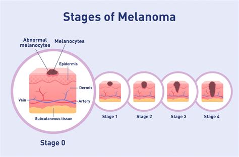 Stage 0 - Melanoma in-situ - Melanoma Focus