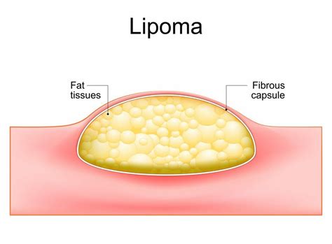 Lipoma Removal: Surgical Procedures And Aftercare - Ask The Nurse Expert