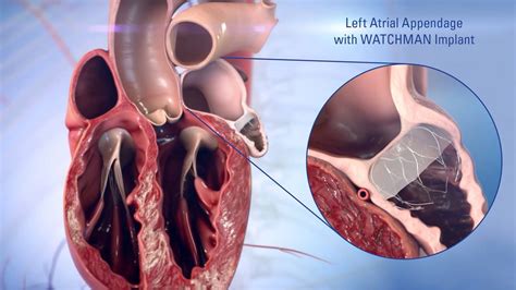 Left Atrial Appendage Closure | Heart Care | Intermountain Healthcare