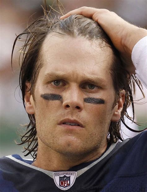 Tom Brady Hair Transplant